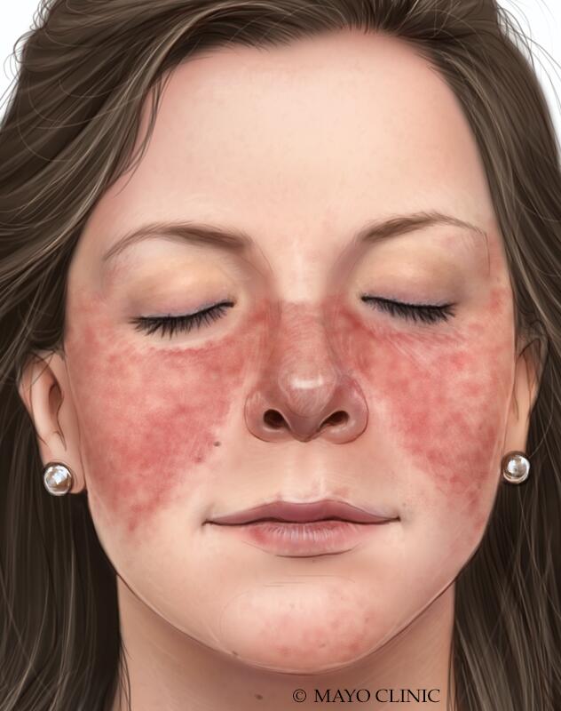 Lupus Rash Pictures: How to Spot Early Warning Signs