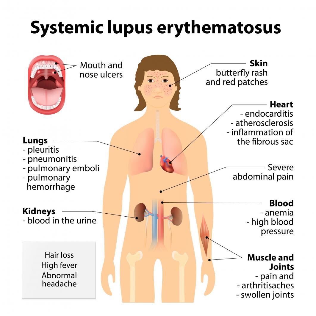 Lupus Rash Treatment: Quick Answers & Effective Options