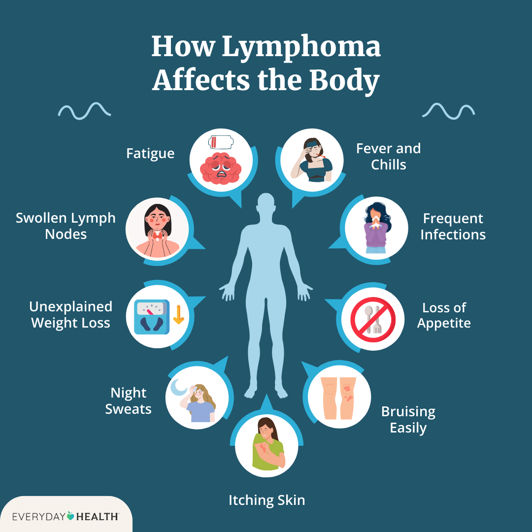 Lymphoma Symptoms: Key Signs You Shouldn't Ignore Today