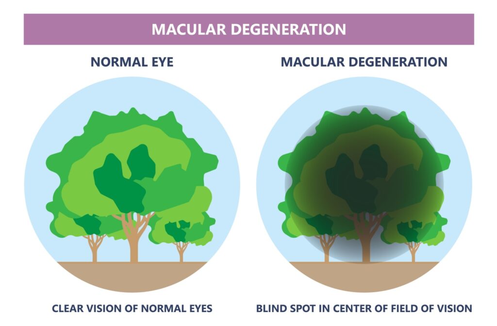 Macular Degeneration Blurred Vision: What It Means