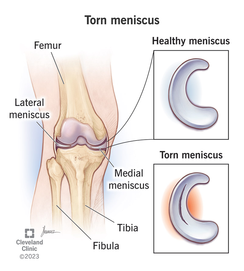 Meniscus Tear Treatment: Options, Recovery & Tips