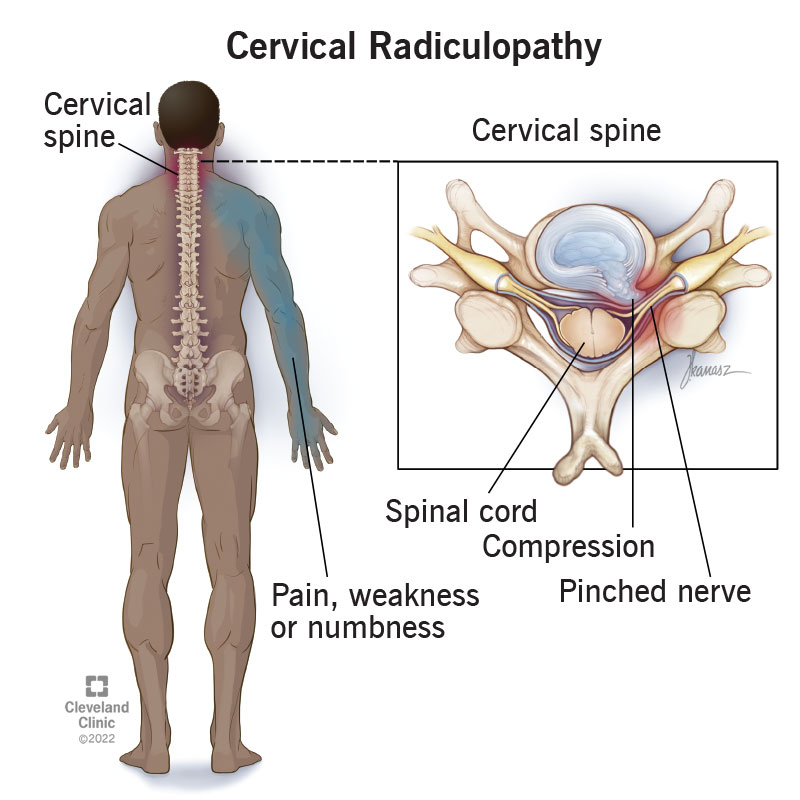 Nerve Compression Symptoms: Spot, Treat & Heal Fast
