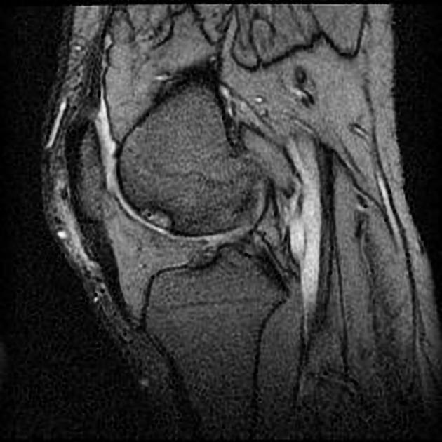 Osteochondritis Dissecans MRI – What You Need to Know