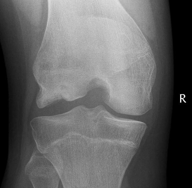 Osteochondritis Dissecans X-ray: What You Need to Know