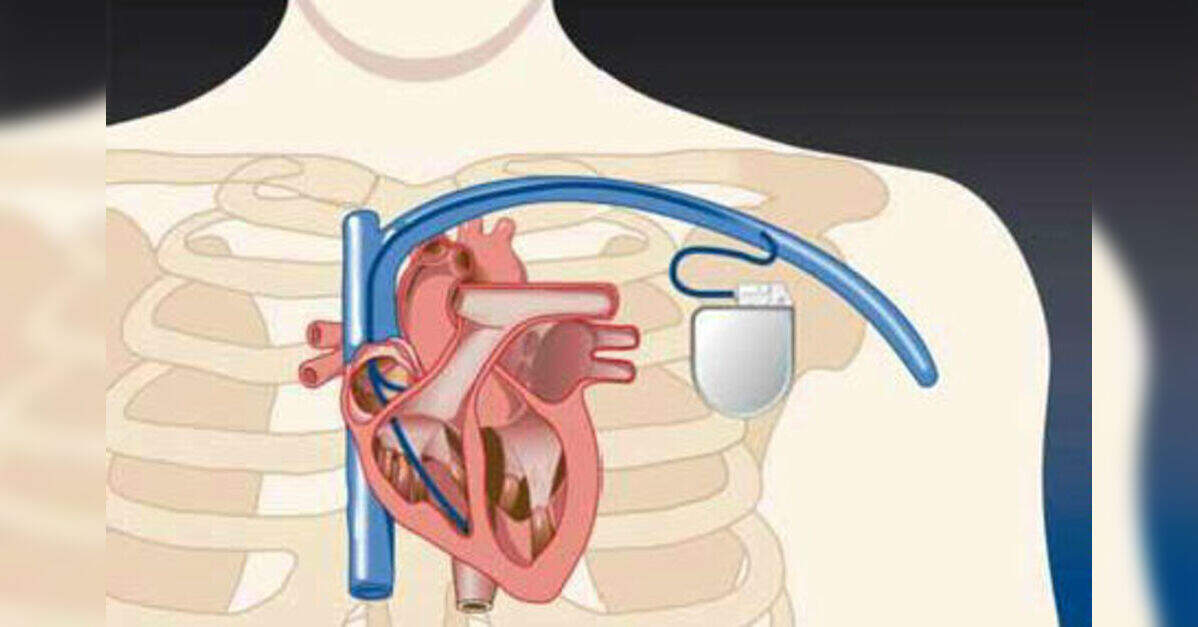 How Much Does a Pacemaker Cost? Your Complete Guide