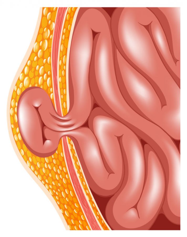 Parastomal Hernia Symptoms: What to Watch For