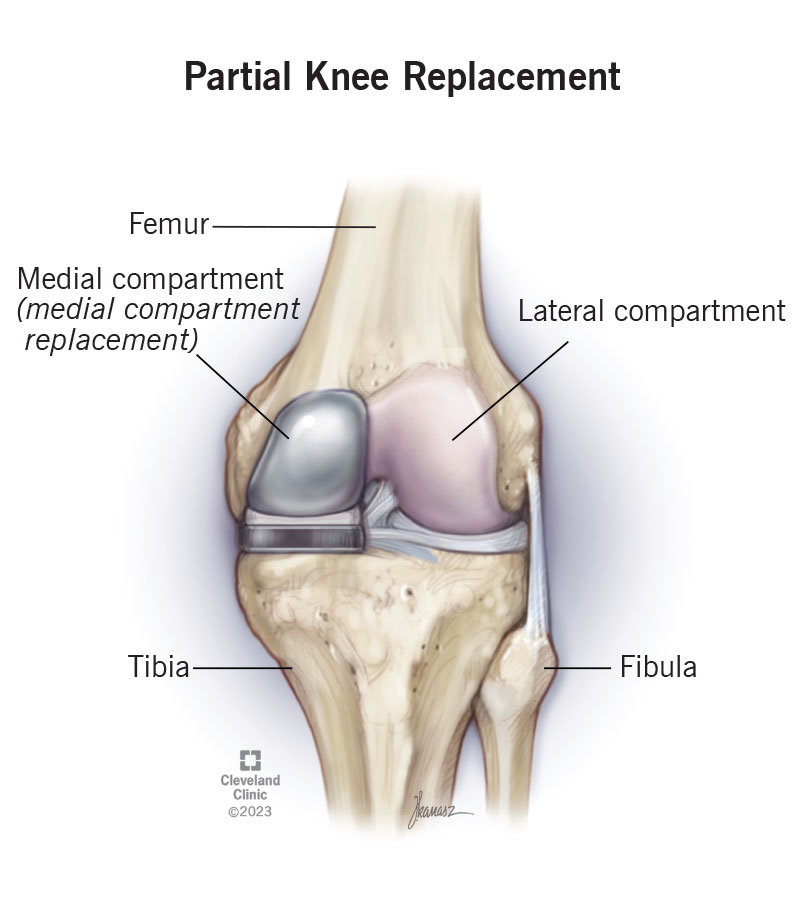 Partial Knee Cost: What You Really Need to Know