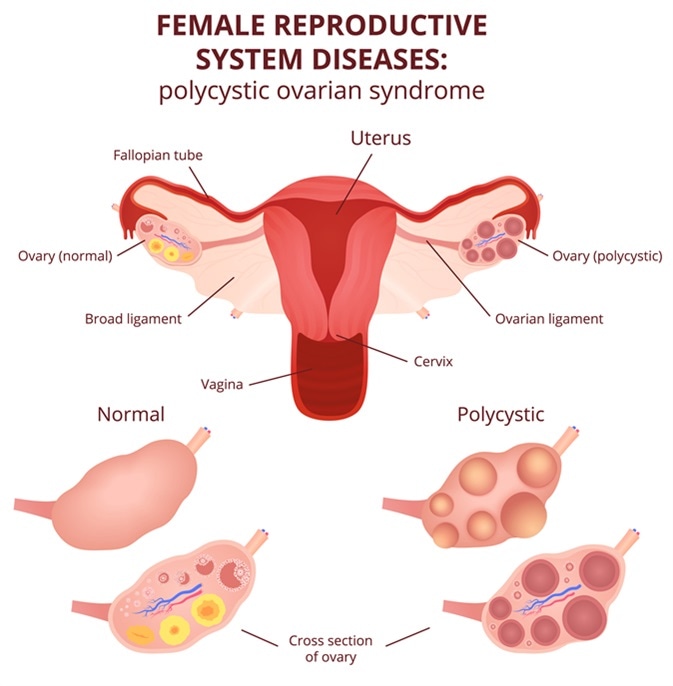 PCOS Metabolic Issues: What They Are & How to Manage