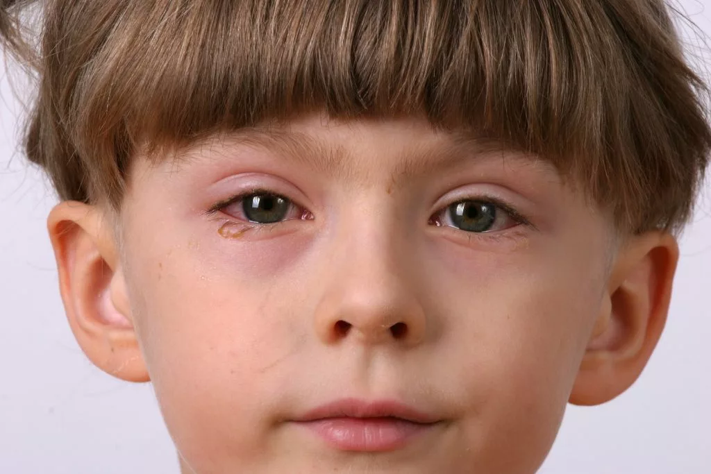 Pink Eye in Toddlers: Quick Relief & Safe Care Guide