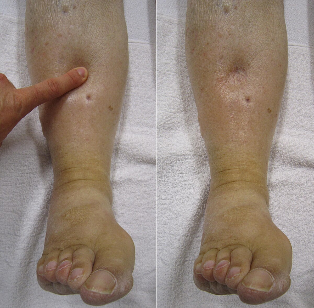 Pitting Edema Causes: Quick Guide to Why It Happens
