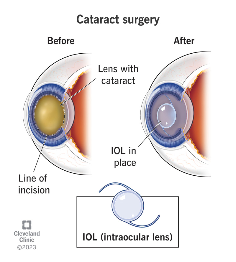 Post Cataract Surgery: Your Essential Recovery Guide