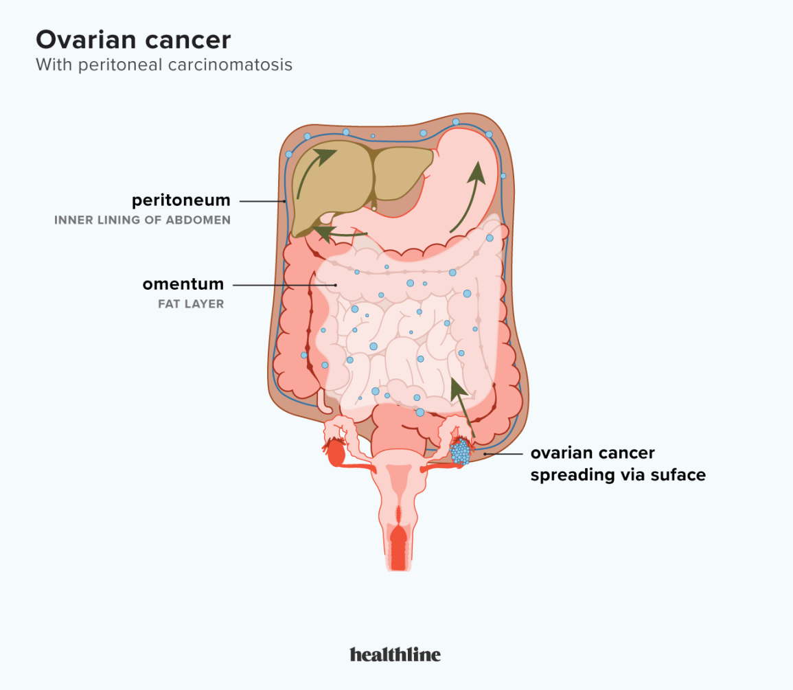 Comprehensive Primary Peritoneal Cancer Treatment Guide