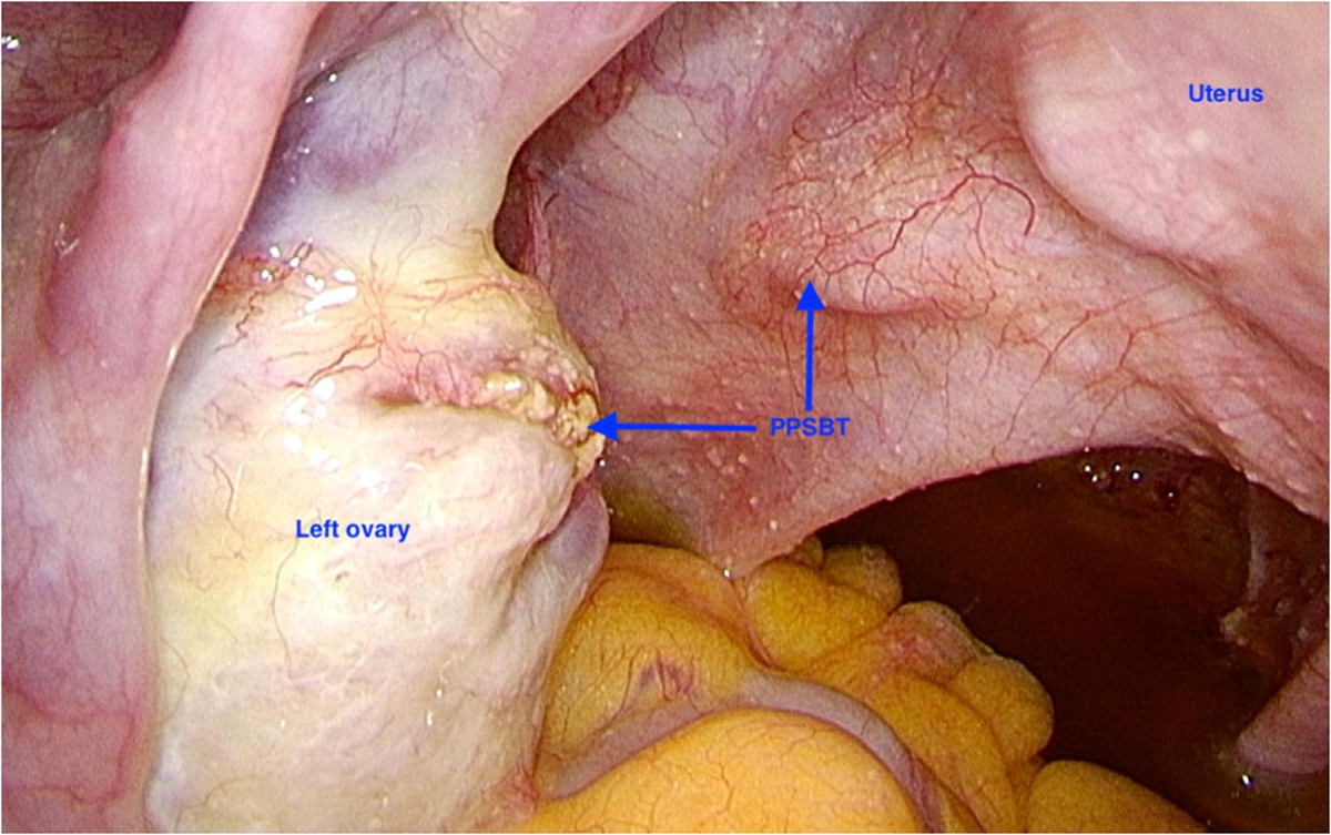 Primary Peritoneal Cancer: Symptoms, Diagnosis & Care