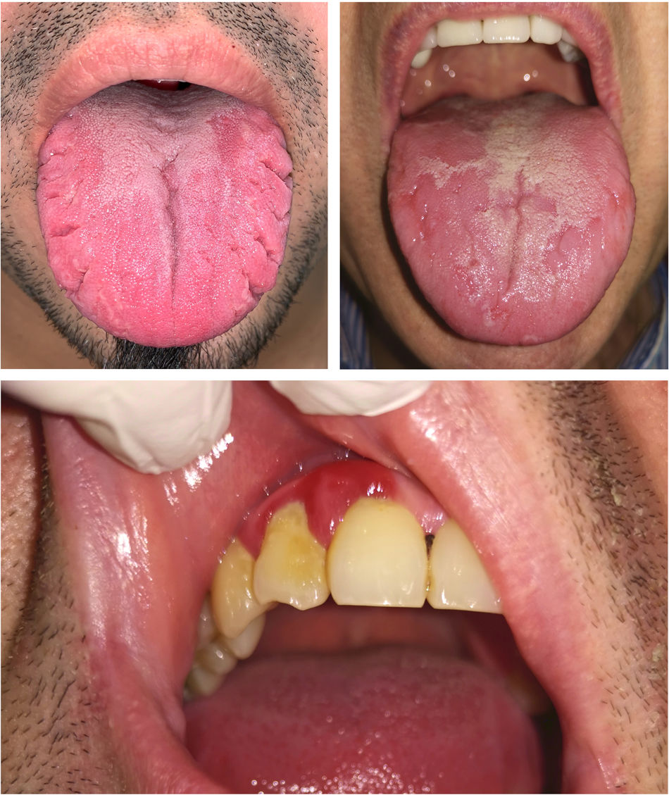 Psoriasis Dental Health: What You Need to Know Today