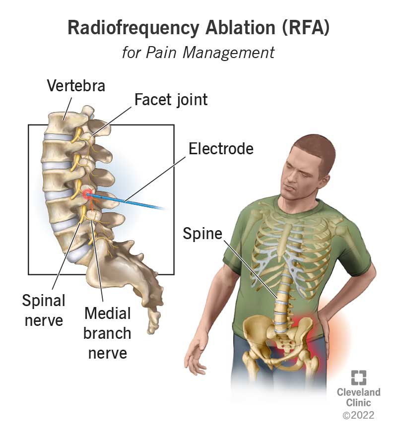 Radiofrequency Ablation Procedure: Quick Guide