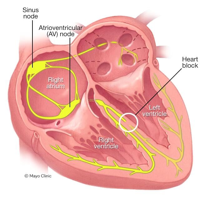 RBBB Symptoms: What They Are, Causes & How to Manage