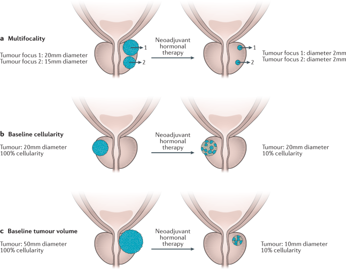 Refusing Hormone Therapy for Prostate Cancer: What You Need to Know