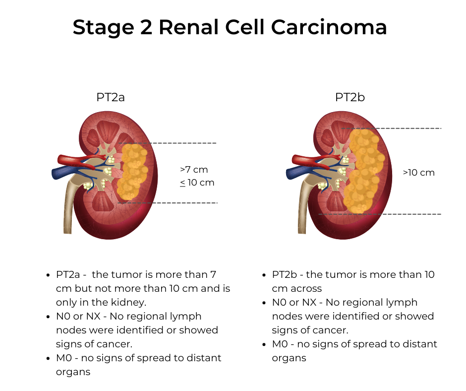 Renal Cancer Stage 2: Essential Facts & Treatment Guide