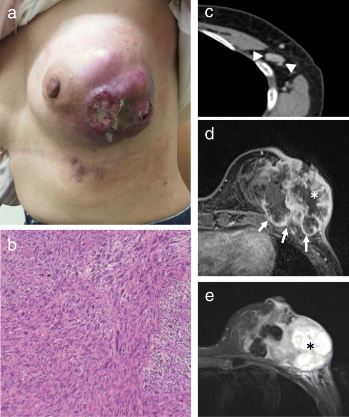 Sarcoma Chemotherapy: Essential Guide for Patients