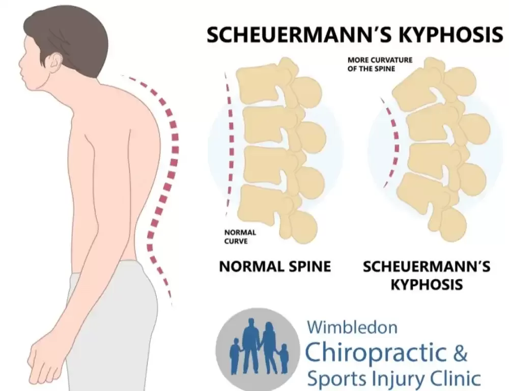 Scheuermann Diagnosis: Key Facts & Treatment Guide