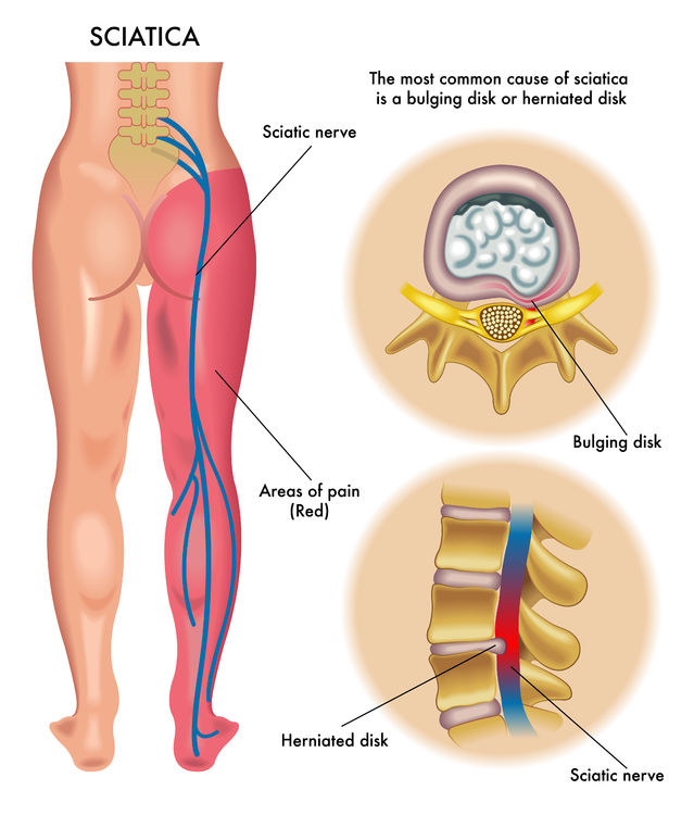 Sciatica Causes: What Triggers That Burning Leg Pain?