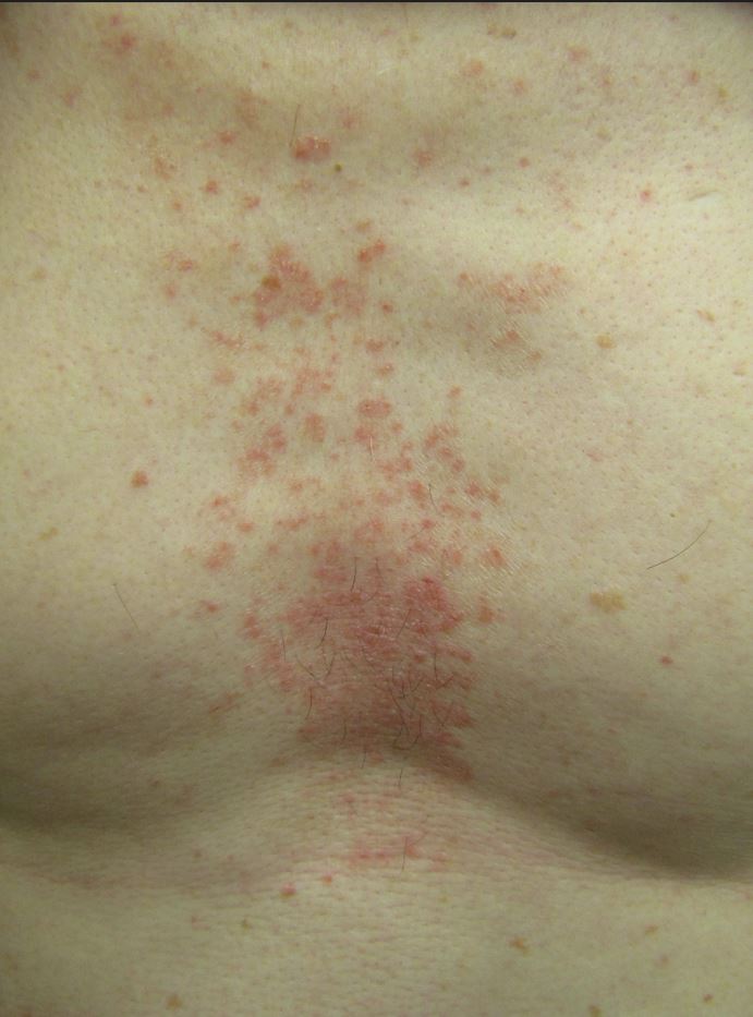 Seborrheic Dermatitis Chest: Symptoms, Causes & Care