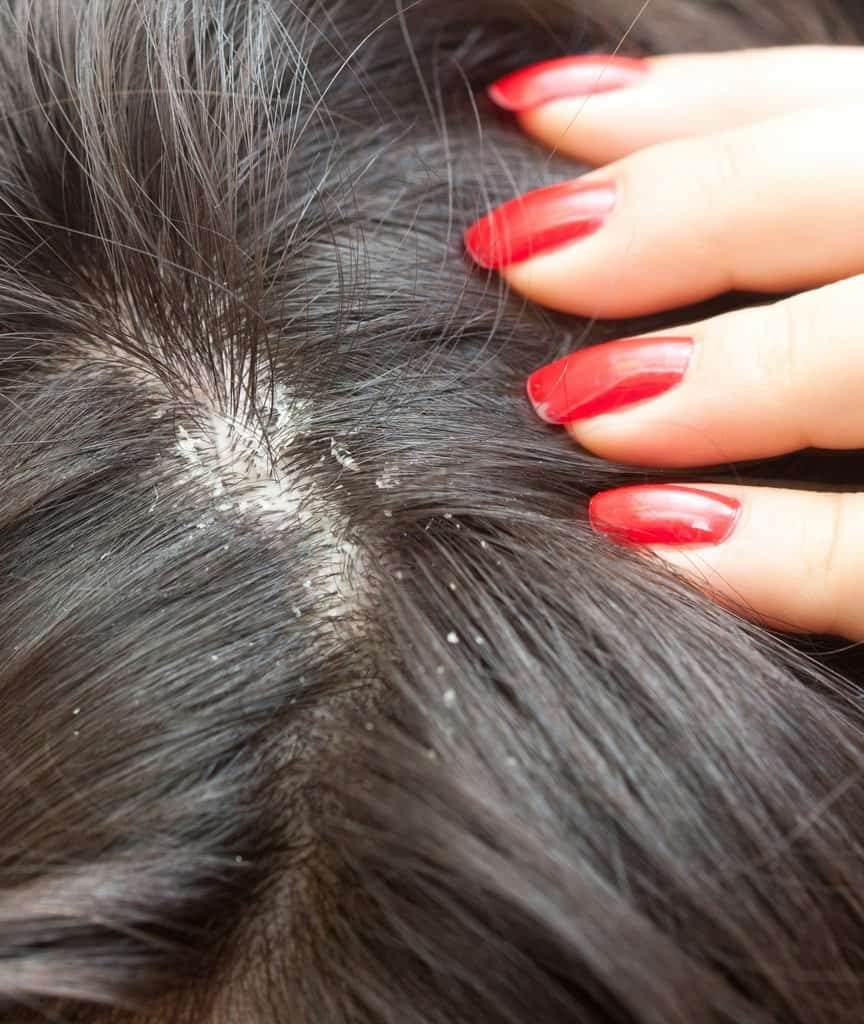 Seborrheic Dermatitis Symptoms: Spot the Signs