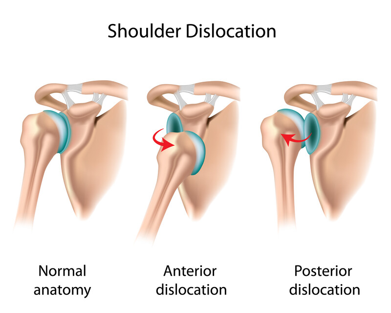 Shoulder Dislocation Risk: Causes, Treatment, Prevention