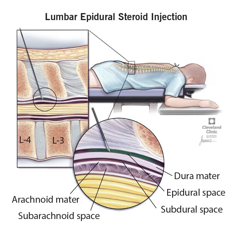 Spinal Injection Risks: Benefits, Side Effects & Safety
