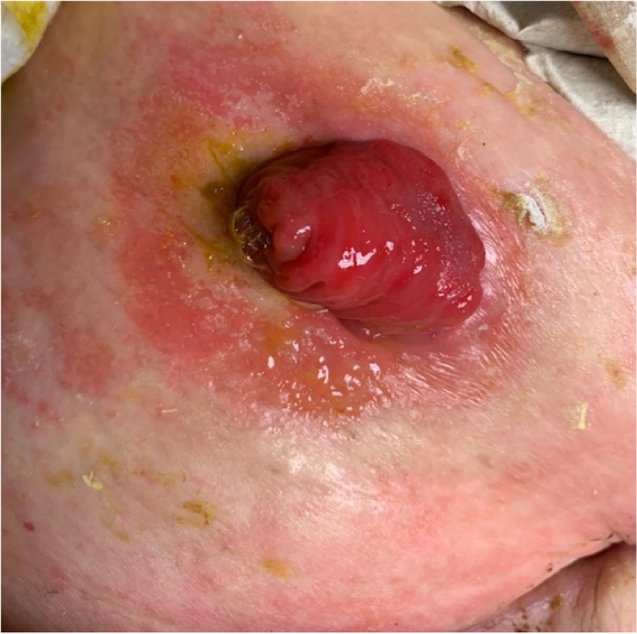 Stoma Dehydration: Signs, Risks & Simple Prevention