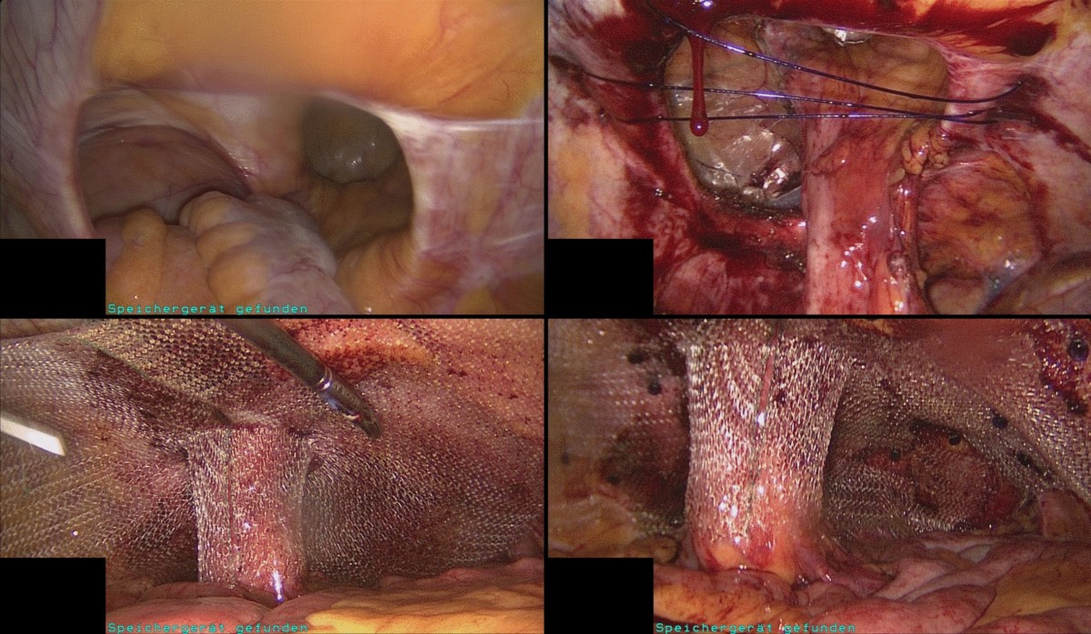 Stoma Hernia Repair: Options, Risks & Recovery