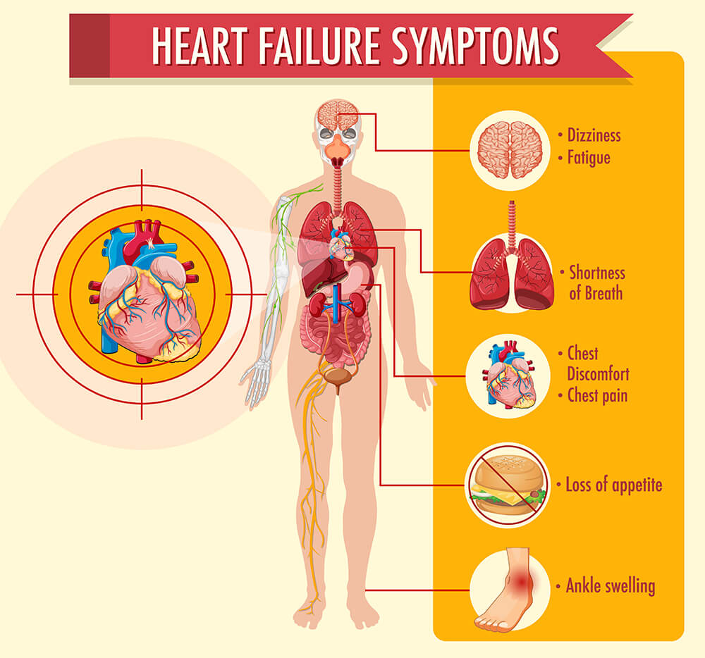 Symptoms of 4 Stages of Heart Failure: Know the Signs