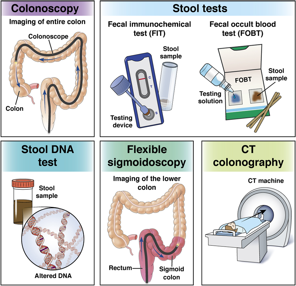 Test for Colon Cancer Without Colonoscopy: Your Guide