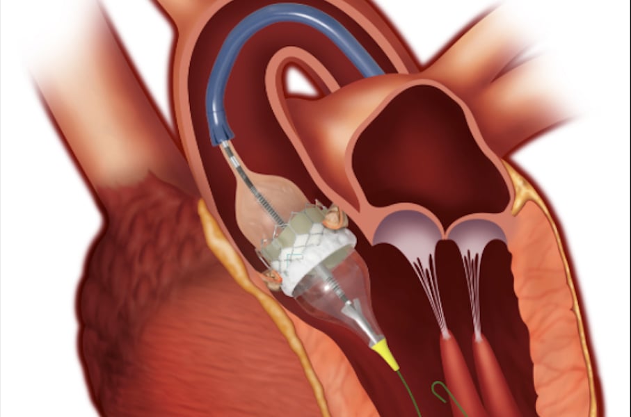 Transcatheter Aortic Valve Replacement: Your Guide