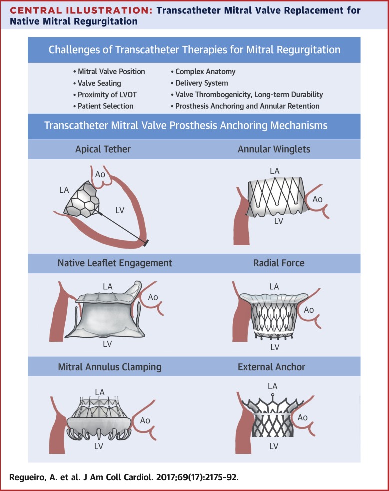 Transcatheter Mitral Valve Replacement: What You Need to Know
