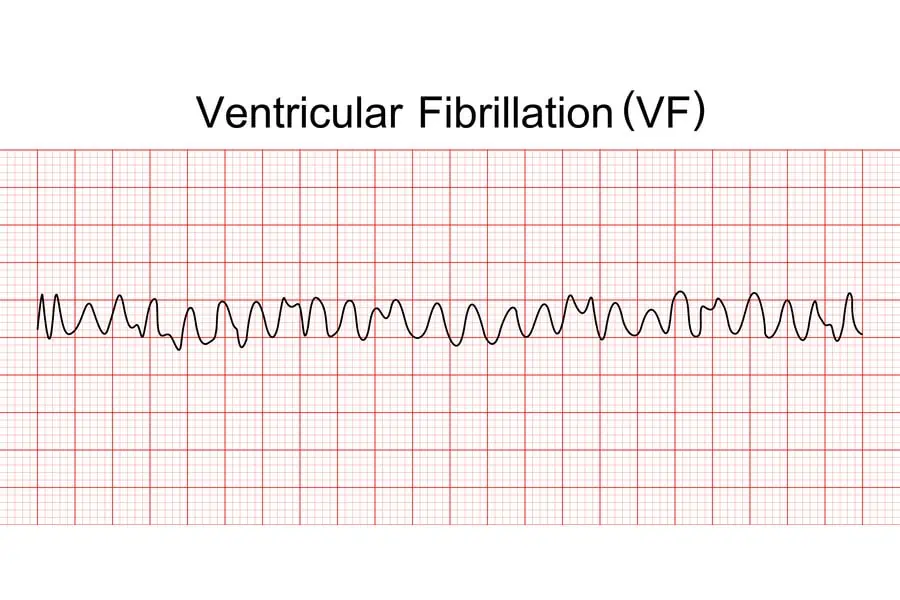 Ventricular Fibrillation: Symptoms, Causes & Treatment