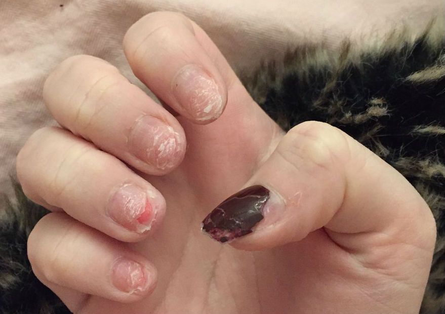 Acrylic Nails Damage: What Really Happens to Your Natural Nails
