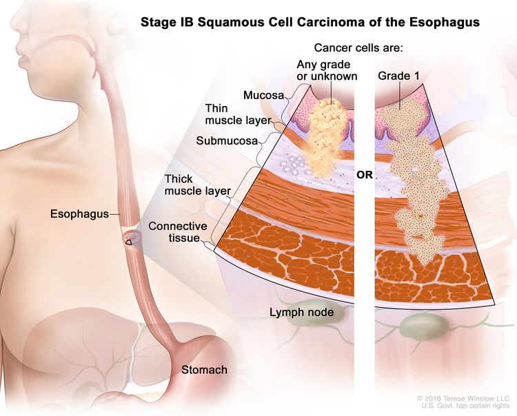 Advanced Esophageal Cancer: Meaning & What to Expect