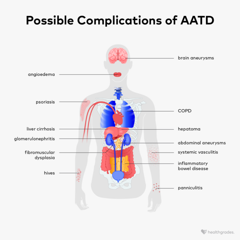 Alpha-1 Deficiency Symptoms: What to Watch For