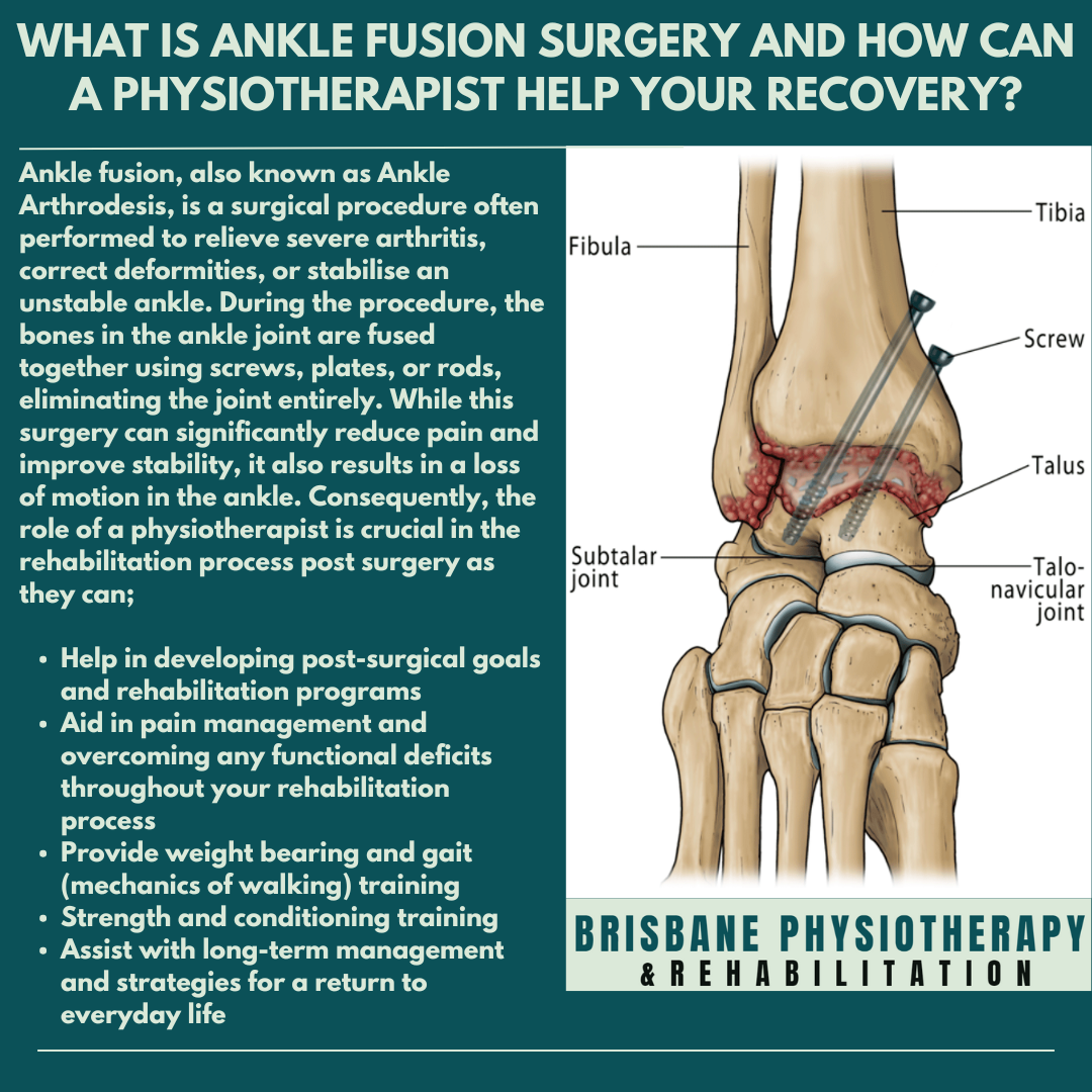 Ankle Fusion Rehabilitation: Steps to Speed Recovery