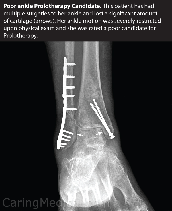 Ankle Surgery Alternatives: Paths to Pain‑Free Mobility