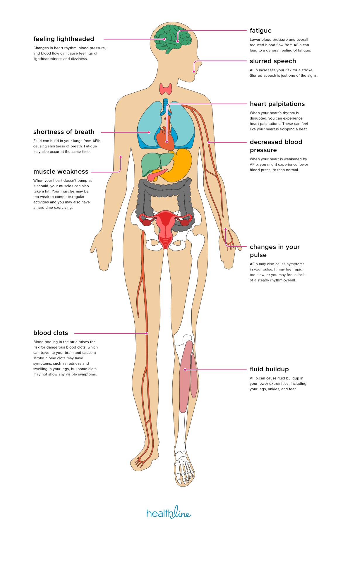 Atrial Fibrillation Complications: What You Need to Know