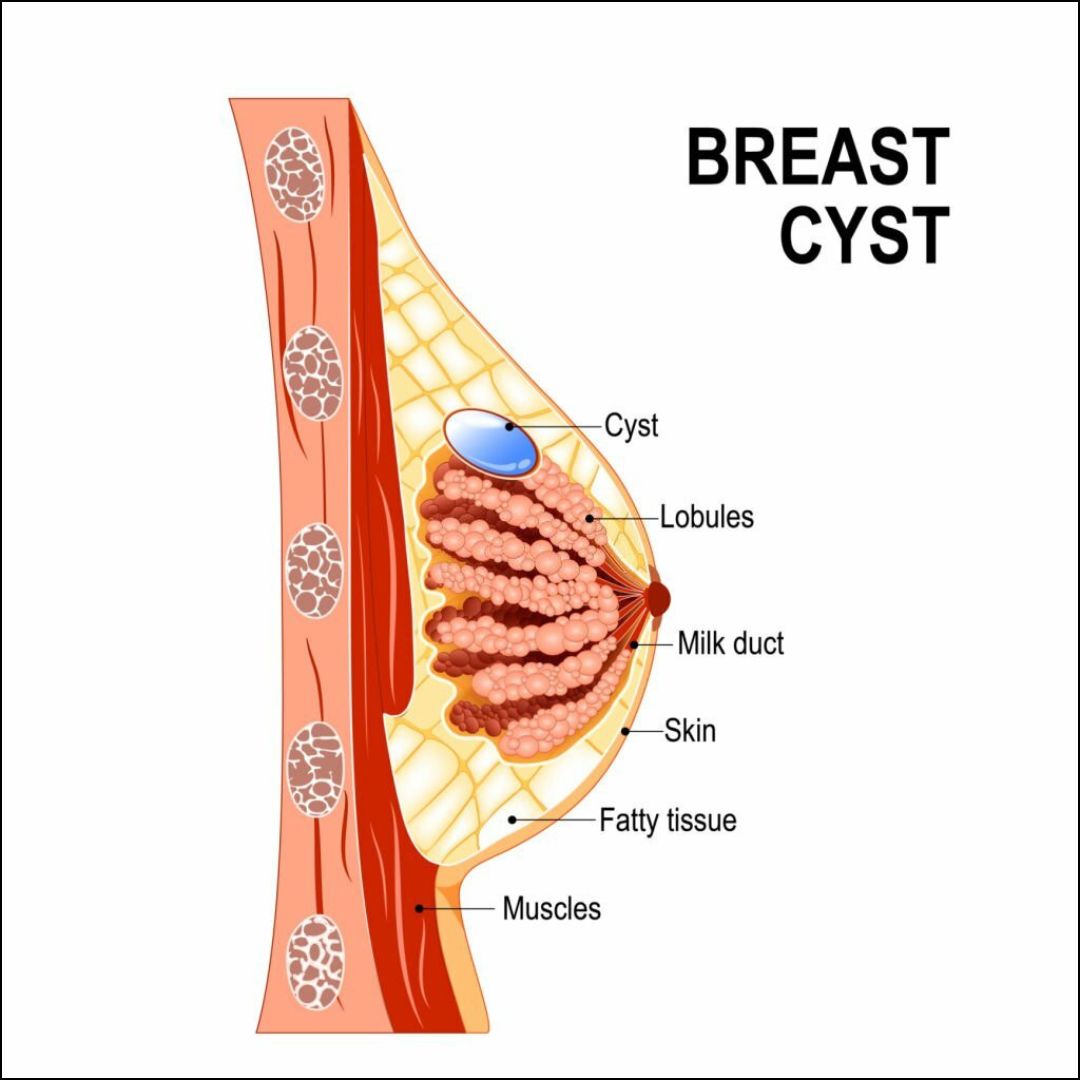 Breast Cyst Causes – What’s Behind Those Lumps?