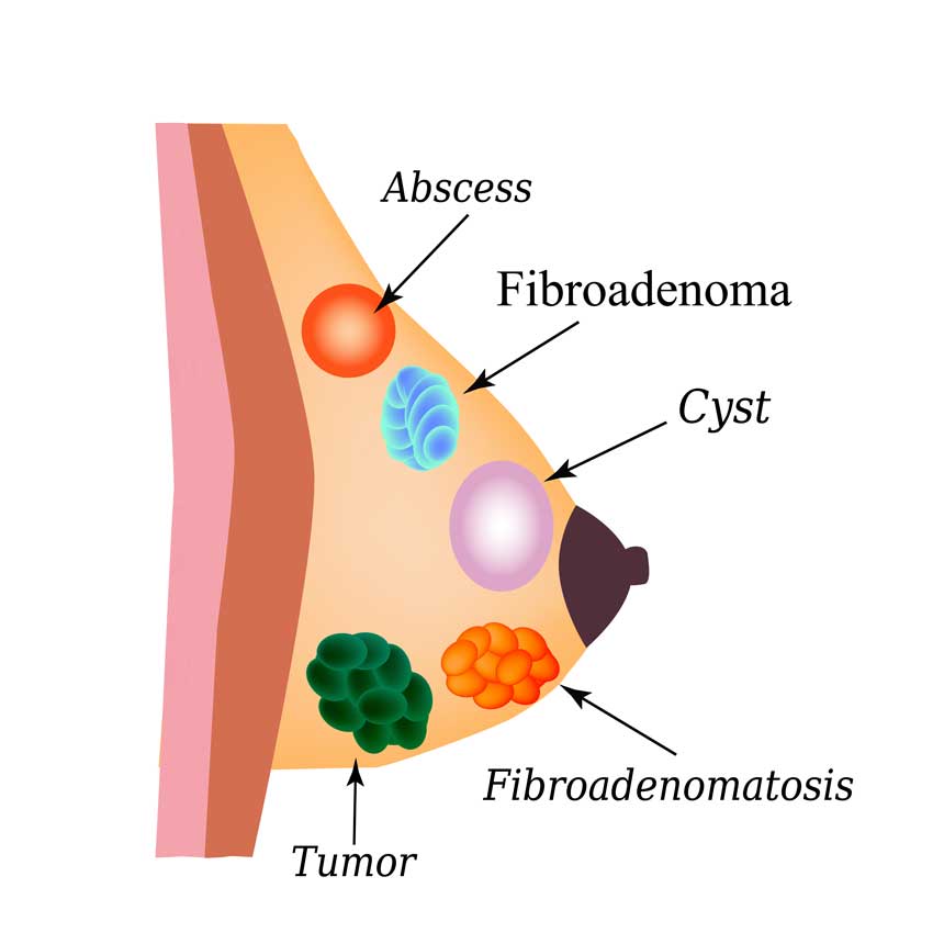Breast Cyst vs Tumor: What Every Woman Should Know