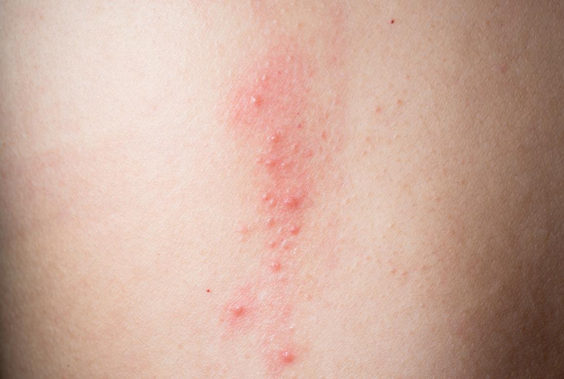 Chest Skin Rash: How to Identify, Treat & When to Worry