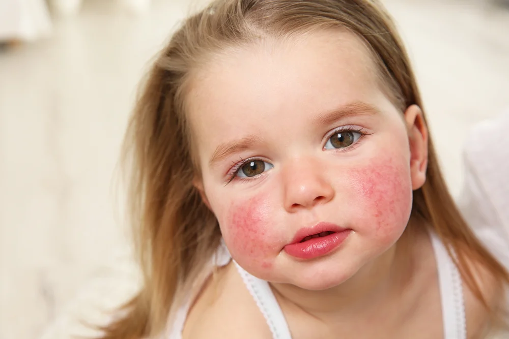 Childhood Pollen Allergy – What Every Parent Needs to Know