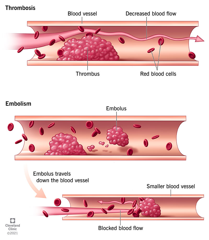 Coronary thrombosis: Risks, symptoms & treatment