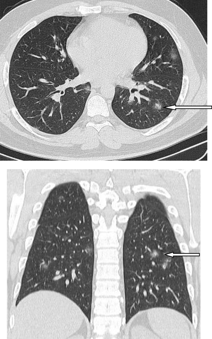 COVID White Patches: What They Mean & When to Act