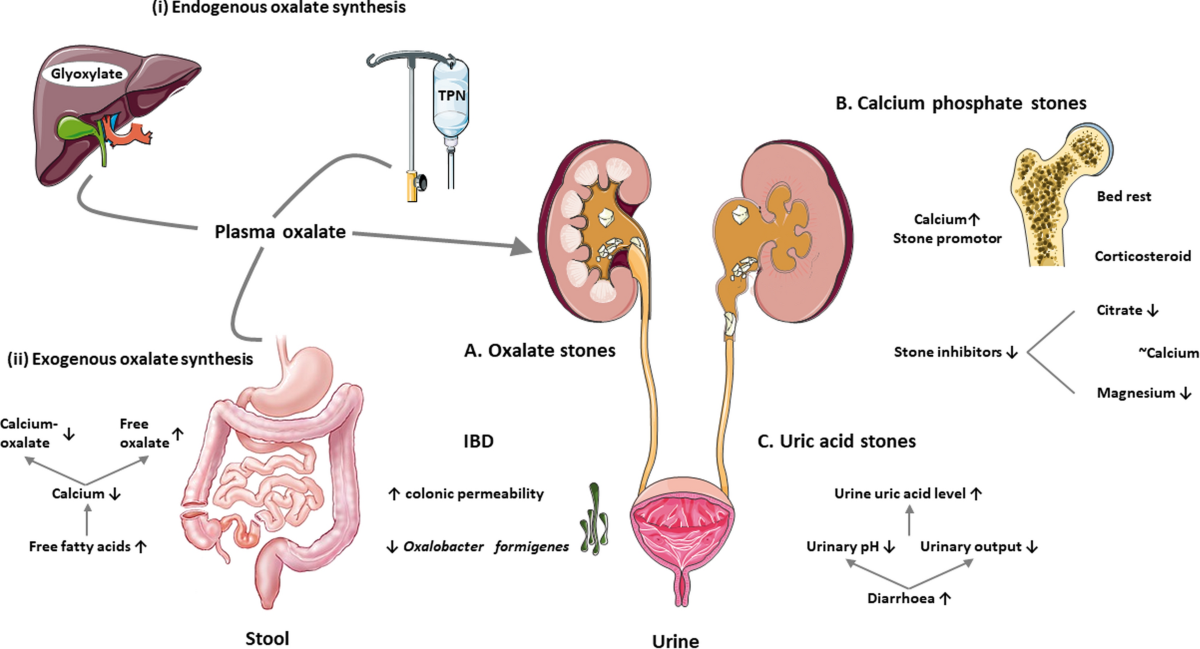 Crohn’s Kidney Issues: What You Need to Know Today
