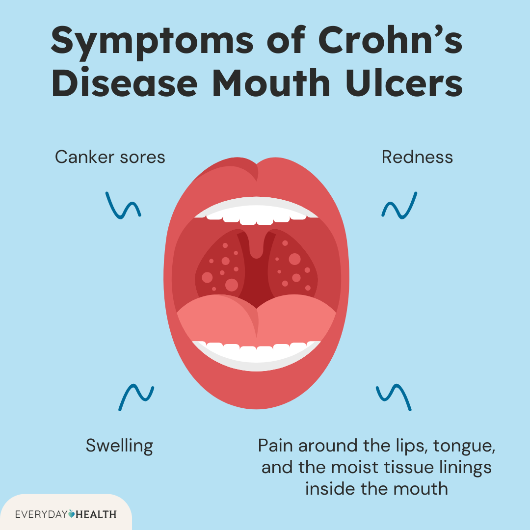 Crohn's Mouth Ulcers: Quick Facts & Helpful Treatments